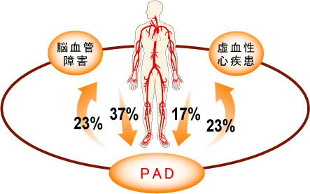 PAD（末梢動脈疾患）図