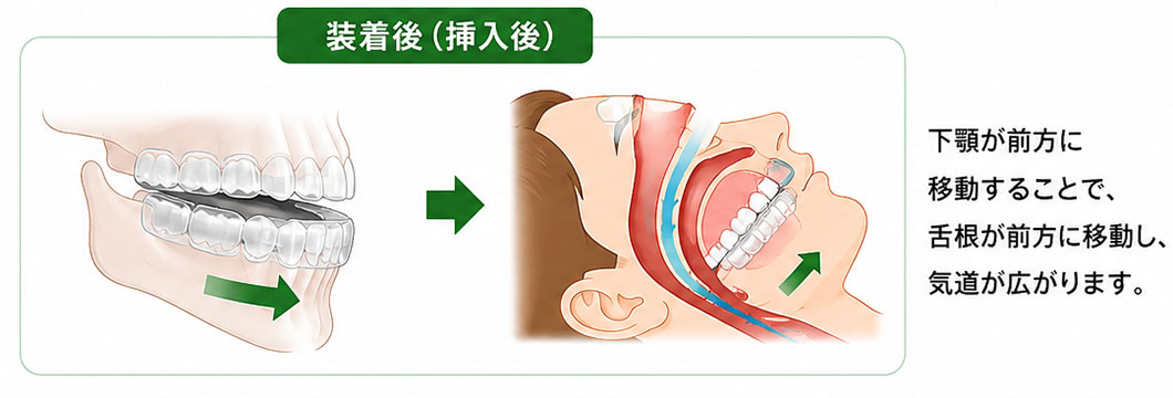 口腔内装置（マウスピース）のイメージ画像
