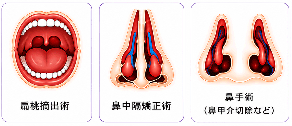 ➄外科的治療（耳鼻科手術）