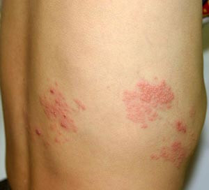 帯状疱疹の症状例写真
